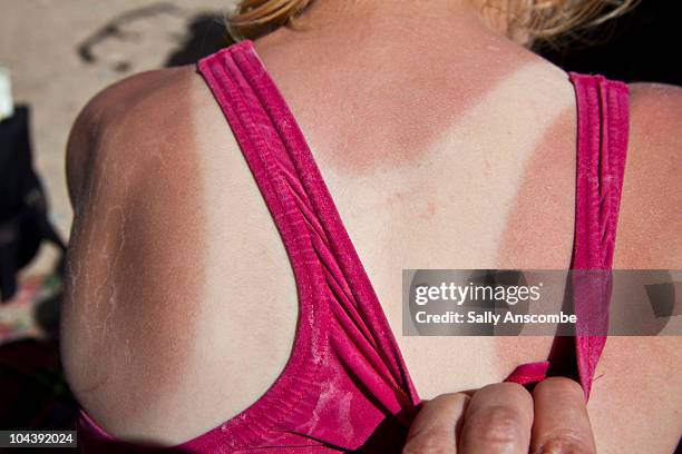 sunburn - sunburnt stock pictures, royalty-free photos & images