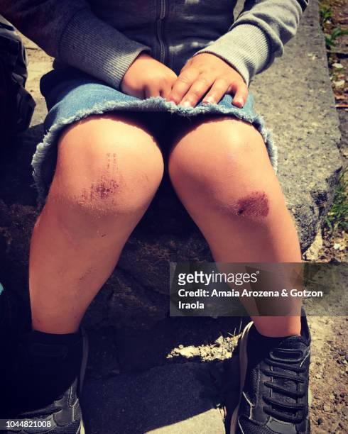 little girl with damaged knees. sicily, italy. - scraped knee stock pictures, royalty-free photos & images