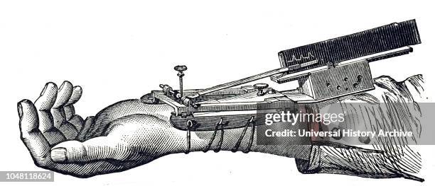 An engraving depicting a sphygmograph, a device invented by etienne-Jules Marey for recording the pulse and variations graphically in blood and...