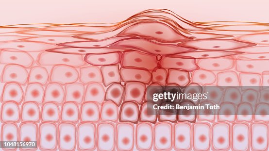 Las células cancerosas del tejido de la piel melanoma Las células cancerosas del tejido de la piel melanoma