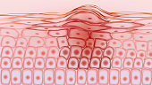 Skin tissue cancerous cells, melanoma