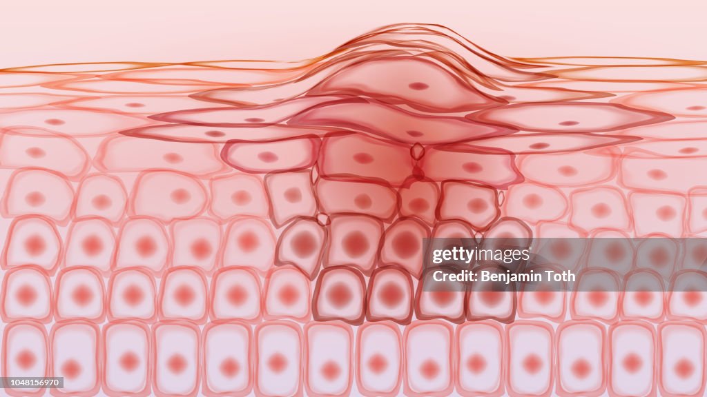 Skin tissue cancerous cells, melanoma