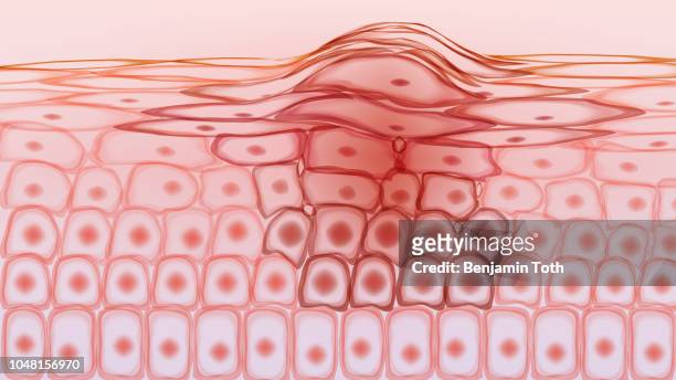 skin tissue cancerous cells, melanoma - human skin stock illustrations