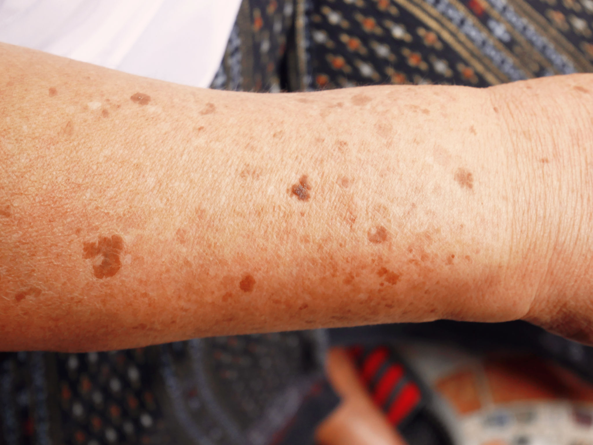aging skin