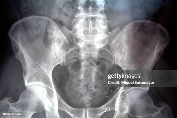 radiography - pélvis imagens e fotografias de stock