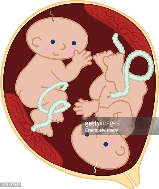 twin fetuses - placenta 幅插畫檔、美工圖案、卡通及圖標