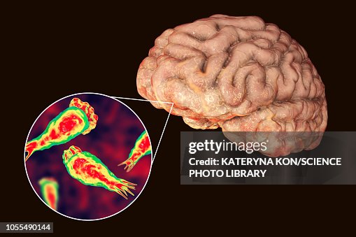 Brain-eating amoeba infection, illustration Brain-eating amoeba infection, illustration