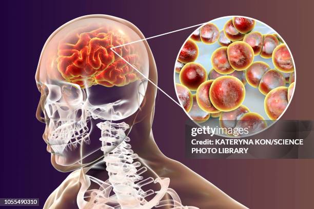 neisseria meningitidis brain infection, illustration - meningococcal stock-grafiken, -clipart, -cartoons und -symbole