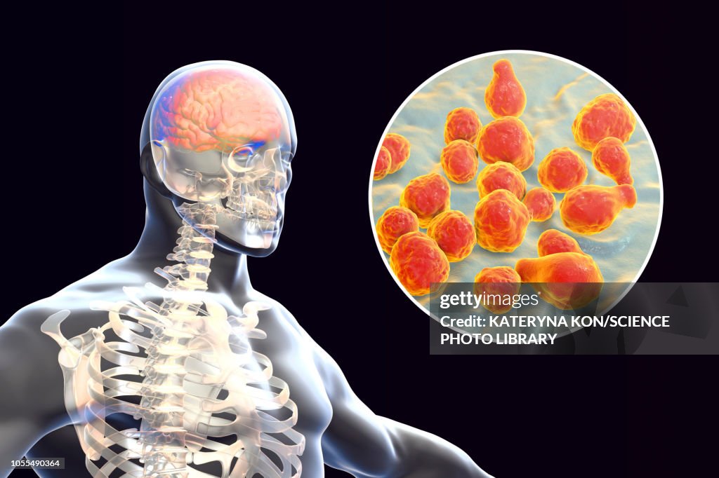 Fungal meningitis, illustration