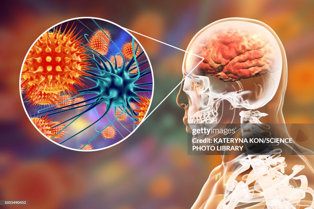 Sore Brain Viral Encephalitis Illustration High-Res Vector Graphic - Getty Images