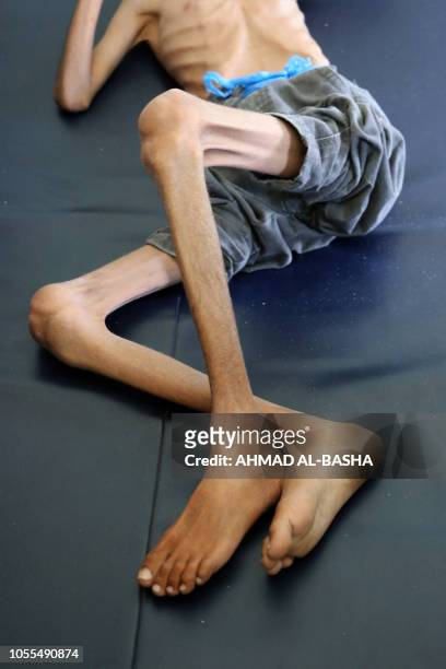 Yemeni boy Ghazi Ali bin Ali suffering from severe malnutrition lies on a bed at a hospital in Jabal Habashi on the outskirts of the city of Taiz, on...