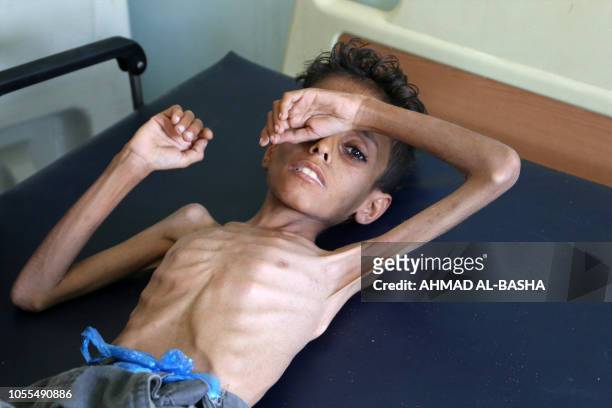 Yemeni boy Ghazi Ali bin Ali suffering from severe malnutrition lies on a bed at a hospital in Jabal Habashi on the outskirts of the city of Taiz, on...