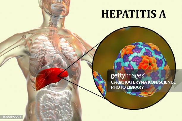 ilustraciones, imágenes clip art, dibujos animados e iconos de stock de hepatitis a infection, illustration - hepatitis a