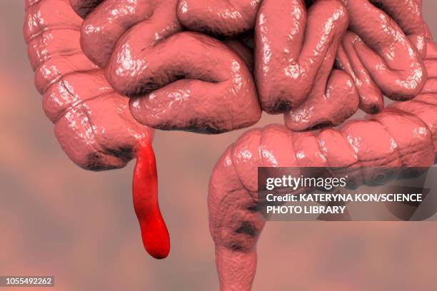 appendicitis, illustration - appendix stock illustrations