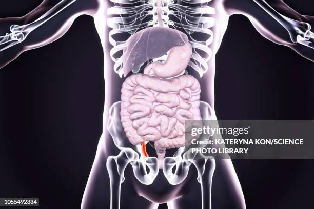 appendicitis, illustration - appendicitis stock illustrations