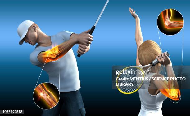 ilustrações de stock, clip art, desenhos animados e ícones de sports elbow injuries, illustration - cotovelo