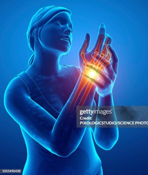 woman with wrist pain, illustration - arthritis hand 3d stock illustrations