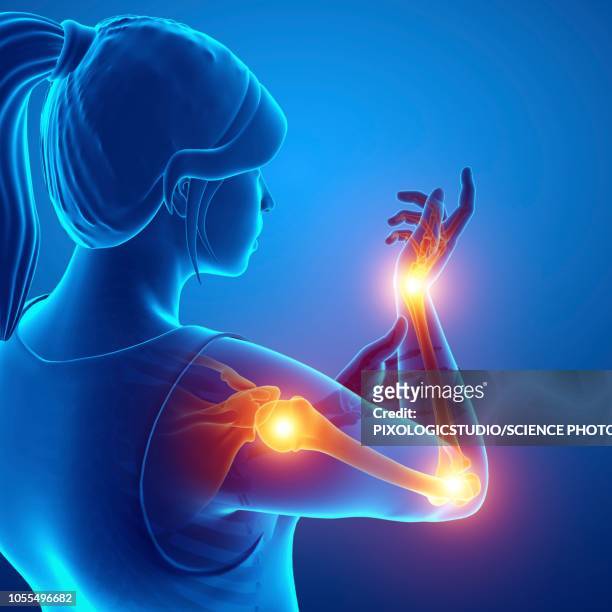 woman with arm pain, illustration - arthritis hand 3d stock illustrations