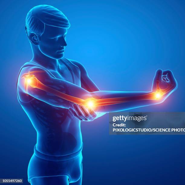 illustrazioni stock, clip art, cartoni animati e icone di tendenza di man with arm pain, illustration - dolore fisico