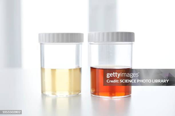 blood in human urine in sample pot - blood urine stock pictures, royalty-free photos & images