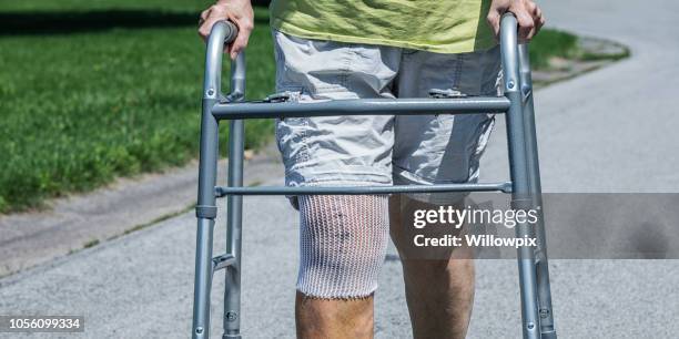 knee replacement surgery medical patient close-up - knee replacement stock pictures, royalty-free photos & images