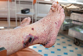 Hemorrhagic vasculitis. Diabetic foot syndrome