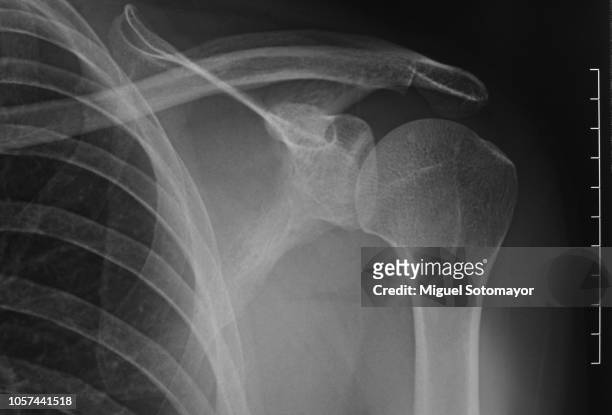 x-ray of the shoulder - x ray arm stock pictures, royalty-free photos & images