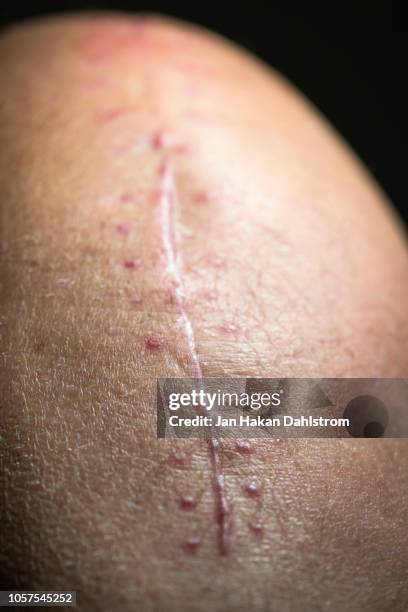 scars on knee after surgery - medical stitches ストックフォトと画像