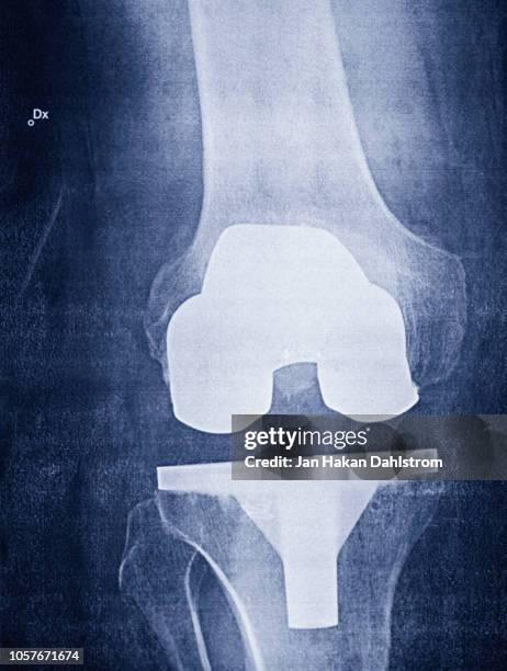 x-ray of prosthetic knee - knee replacement surgery - fotografias e filmes do acervo