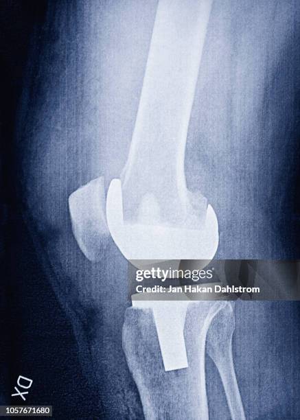 x-ray of prosthetic knee - künstliches kniegelenk stock-fotos und bilder
