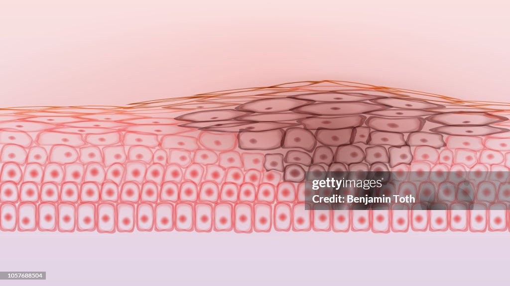 Las células cancerosas del tejido de la piel melanoma