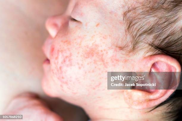 newborn baby with many red spots caused by neurodermatitis, poland - skin condition stock pictures, royalty-free photos & images