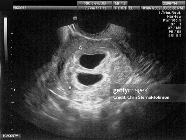 twin ultrasound - foetus stock pictures, royalty-free photos & images