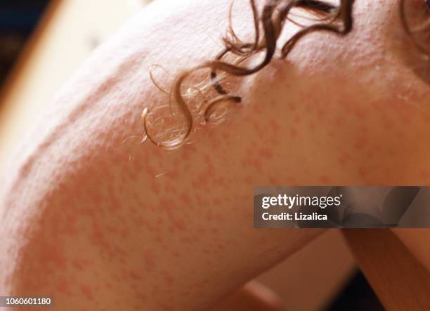 alergia en la piel - psoriasis fotografías e imágenes de stock