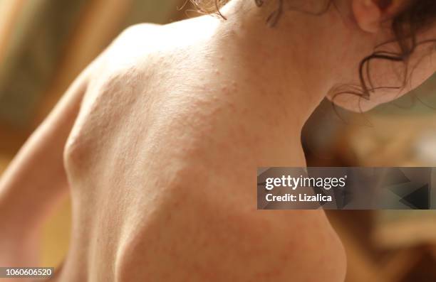 skin allergy - pox stock pictures, royalty-free photos & images