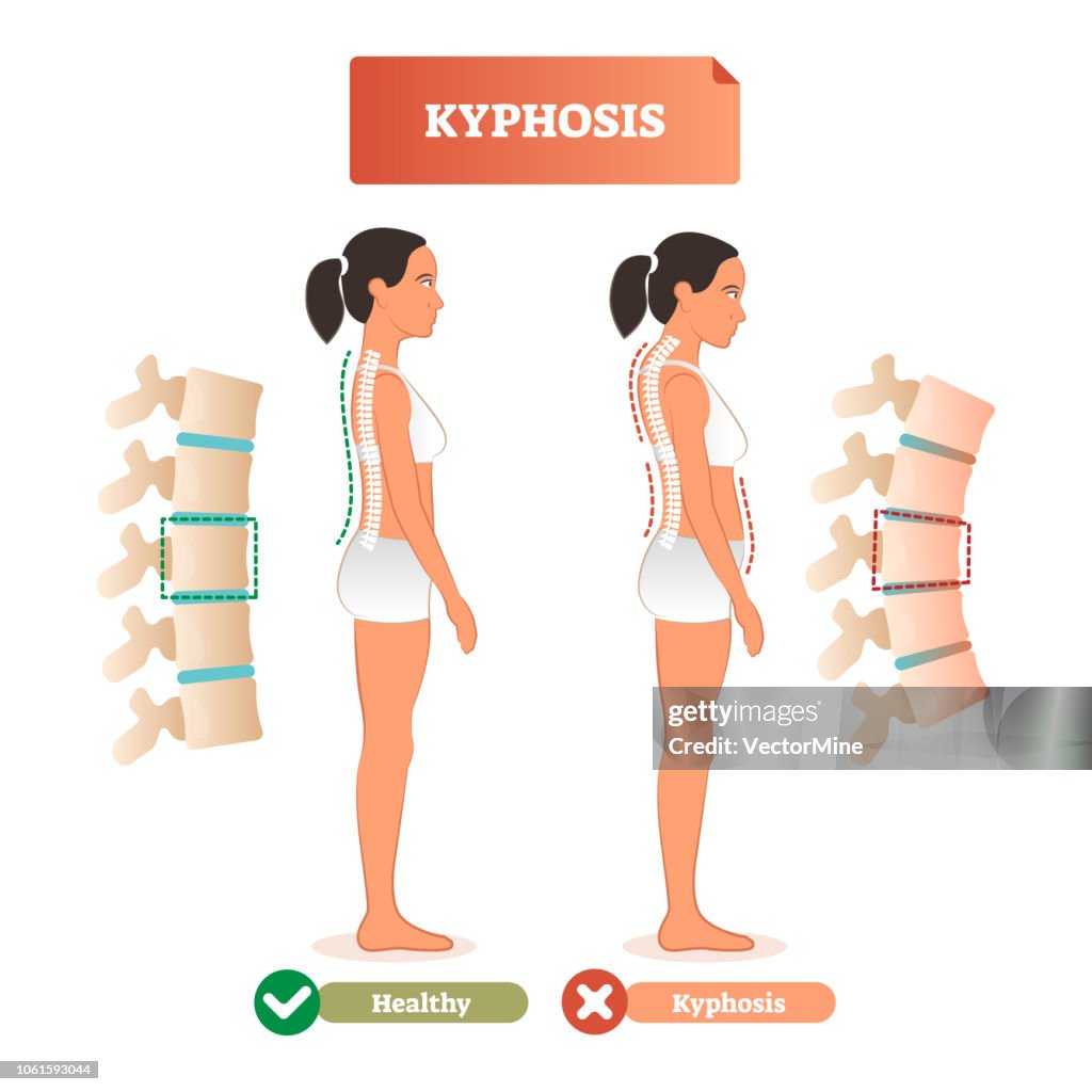 Spinal Defet Kyphosis Vector Illustration Back Spine Defect Diagnosis Vs Healthy ...