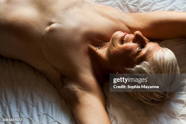 a mature woman with mastectomy scars lying on a bed - mastectomy scar photos et images de collection