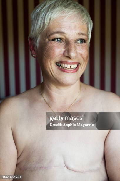 A portrait of a mature woman with mastectomy scars