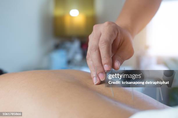 the doctor treats with acupuncture,acupuncture,traditional chinese medicine - acupuncture photos et images de collection