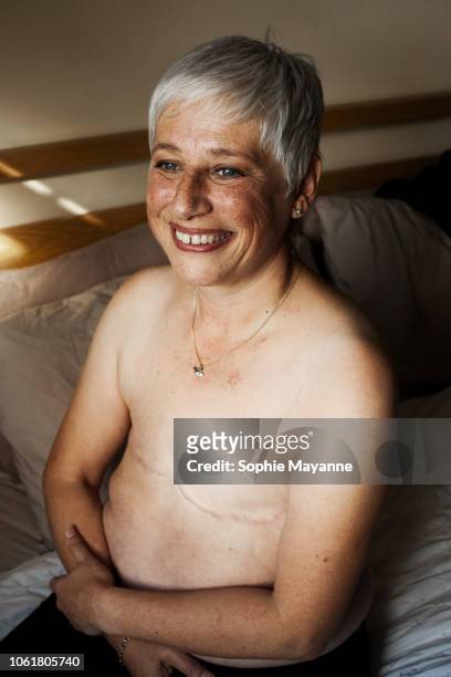 A woman with mastectomy scars smiling