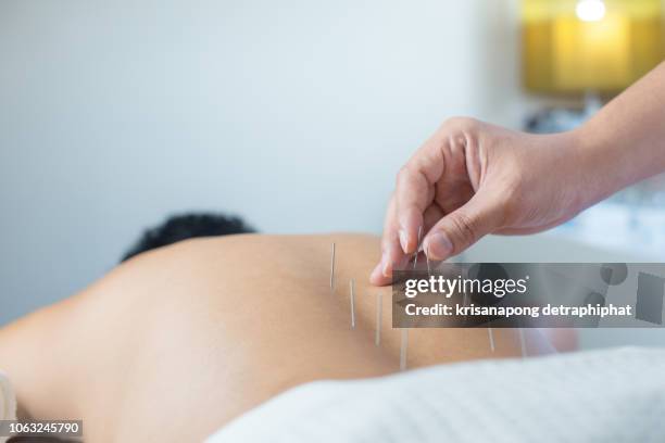 the doctor treats with acupuncture,traditional chinese medicine - agulha de acupuntura imagens e fotografias de stock