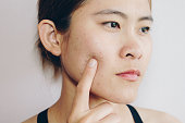 Portrait of Asian woman has problems with skin on her face.