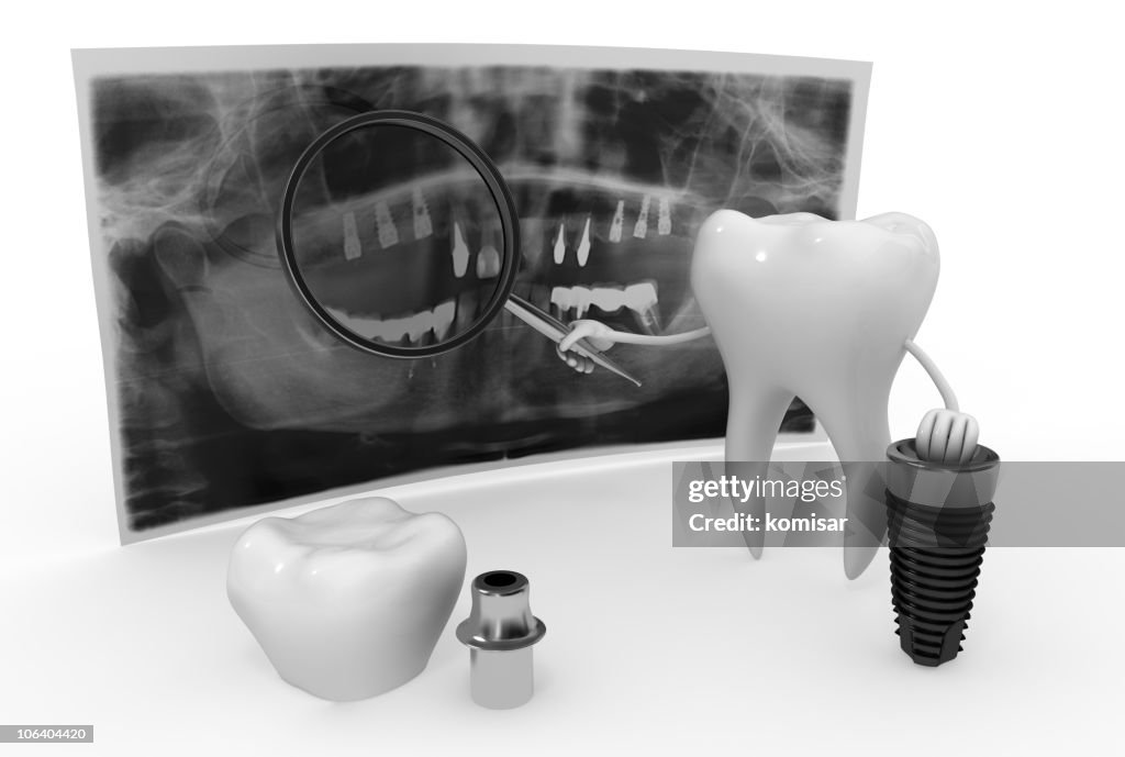 Tecnología de implante dental