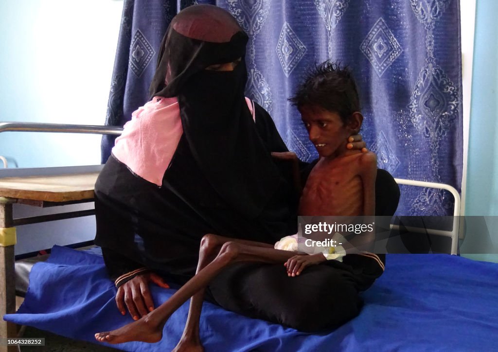 YEMEN-CONFLICT-MALNUTRITION