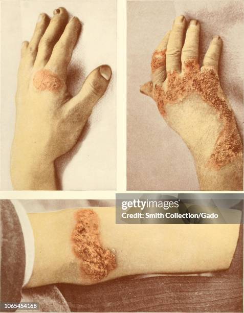 Engravings of human hands infected with tuberculosis verrucosa cutis, red papular nodules in the skin, from the book "Photographic atlas of the...