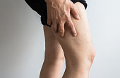 Varicose veins on the elderly womans legs,Close up