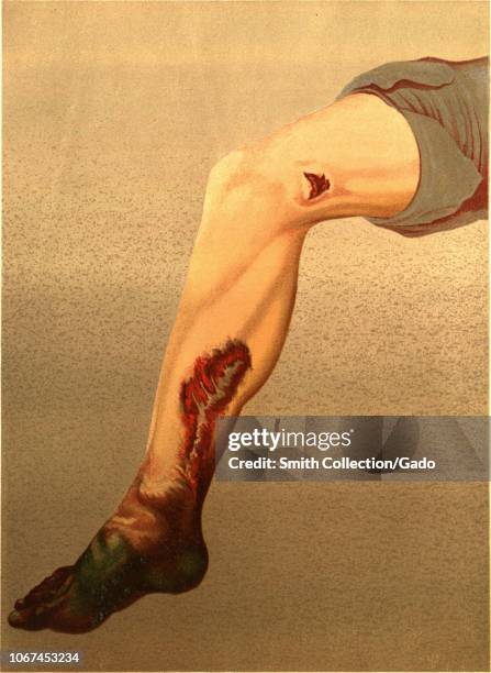 Engraving of a human leg infected with Gangrene following a gunshot laceration of the femoral artery, from the book "The Medical and Surgical History...