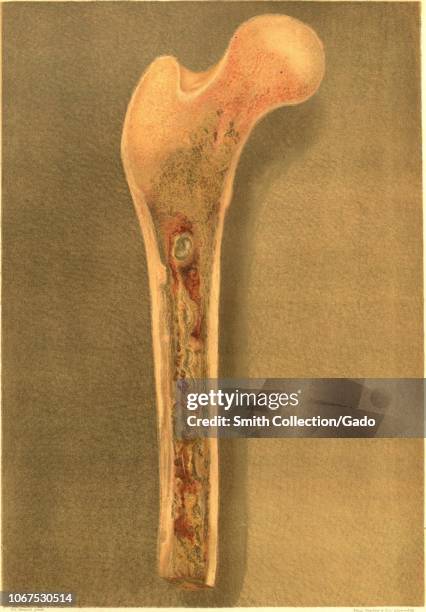 Engraving of the medullary abscesses of the femur, from the book "The Medical and Surgical History of the War of the Rebellion" by U.S. Army Surgeon...