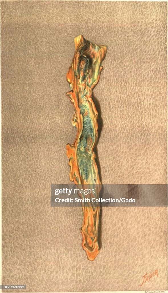 Obstructed Femoral Vein