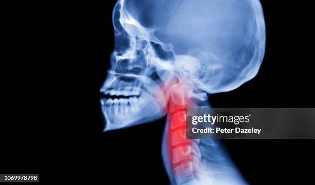 xray of human skull with showing asthma symptoms - faringe - fotografias e filmes do acervo